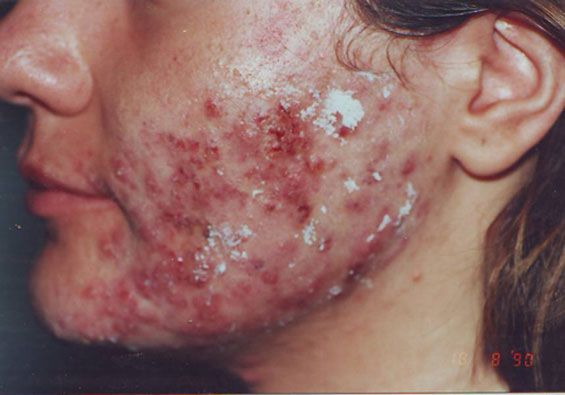 Acnea-Vulgaris-inainte-7