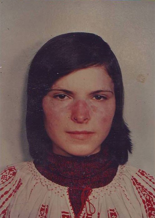 Chronic-Photodermatitis-dupa-3