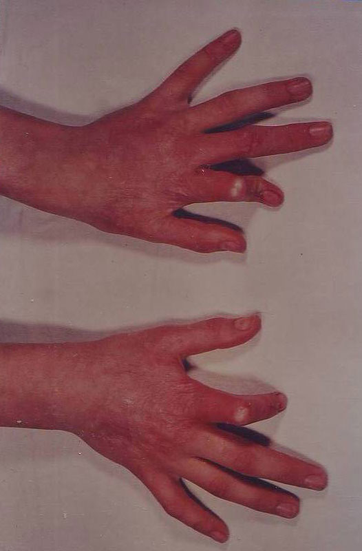 Chronic-Photodermatitis-dupa-4