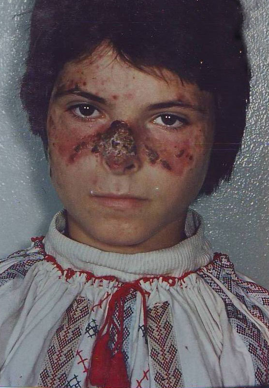 Chronic-Photodermatitis-inainte-3