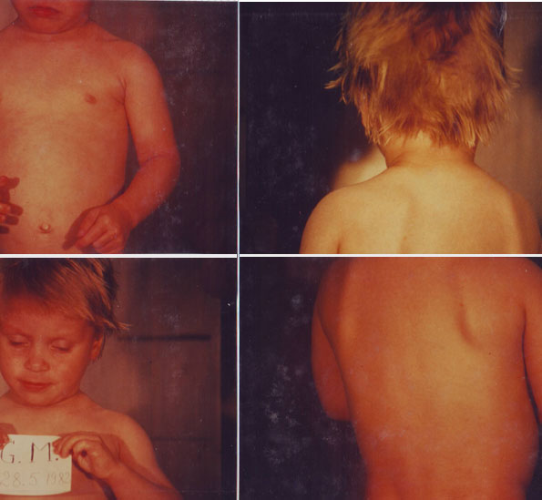 Eczema-Atopica-dupa-17