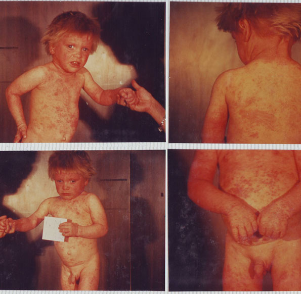 Eczema-Atopica-inainte-17