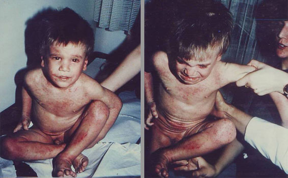 Eczema-Atopica-inainte-6