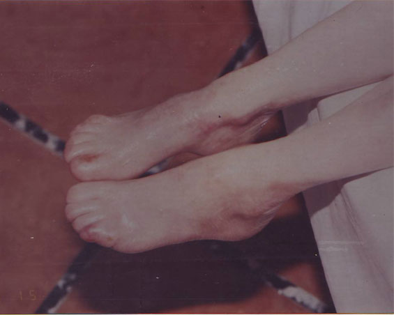 Epidermolysis-Bullosa-Distrophica-dupa-11