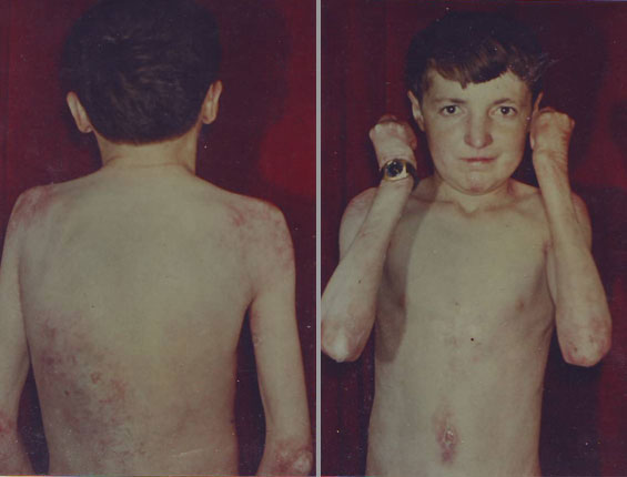 Epidermolysis-Bullosa-Distrophica-dupa-8