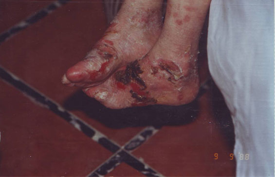 Epidermolysis-Bullosa-Distrophica-inainte-11