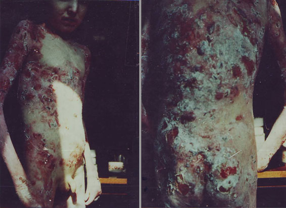 Epidermolysis-Bullosa-Distrophica-inainte-8