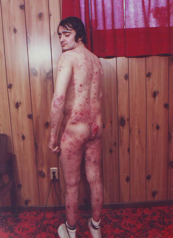 Epidermolysis-Bullosa-Simplex-inainte-10