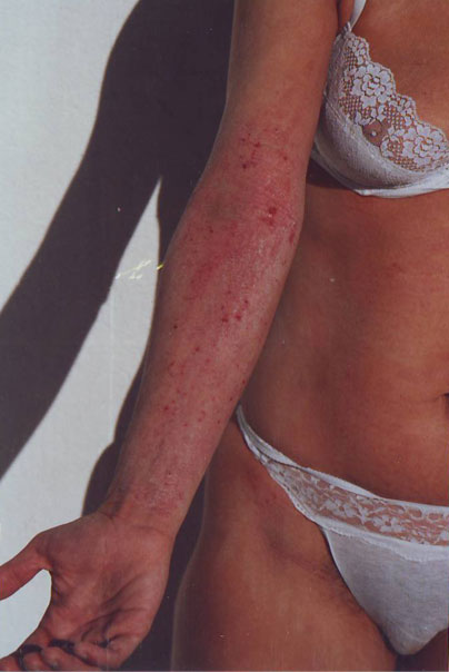 Generalized-Chronic-Eczema-inainte-15