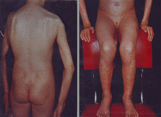 Ichthyosis-Hyperkeratolitic-dupa-2