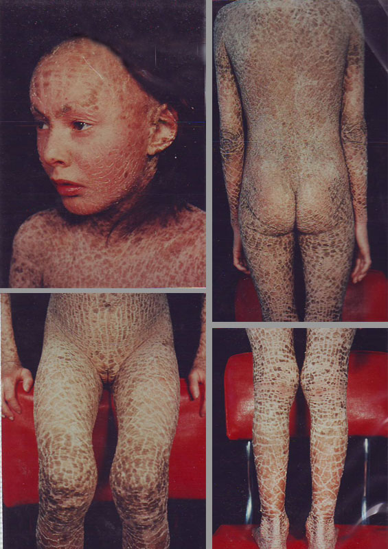 Ichthyosis-Hyperkeratolitic-inainte-2