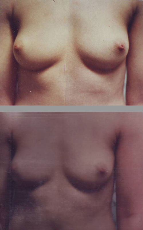 Ichthyosis-Lamellar-dupa-1