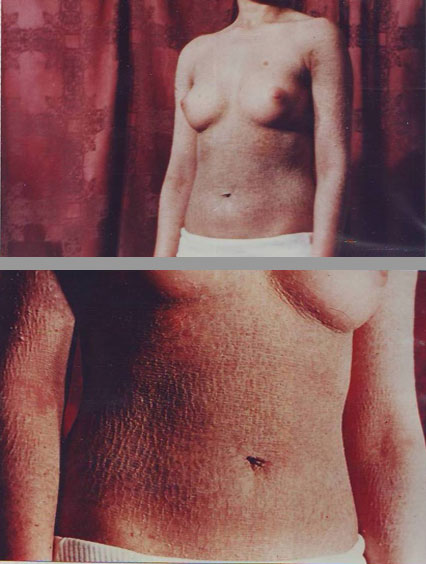 Ichthyosis-Lamellar-inainte-1