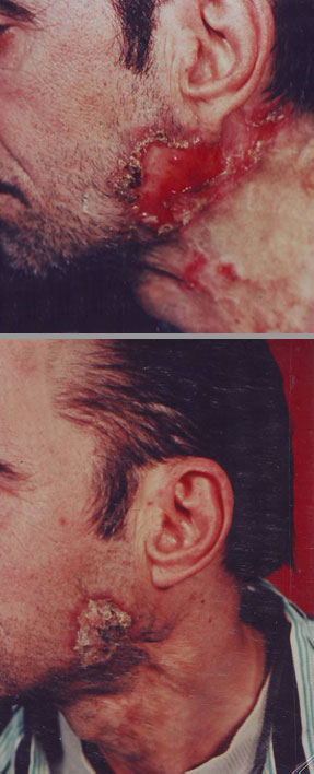 Lupus-Erythematosus—Chronic-Ulcerative-inainte-5