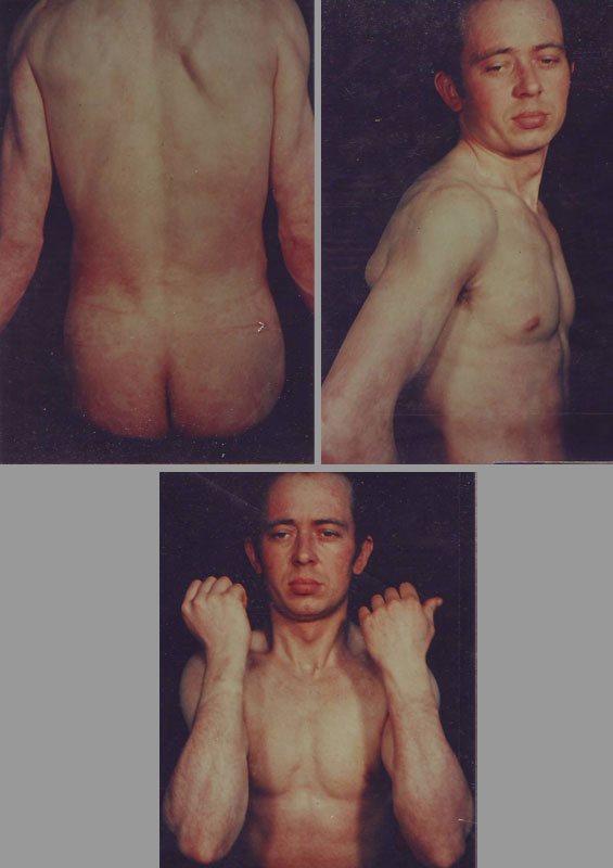 Psoriasis-Vulgaris-Generalized-dupa-9