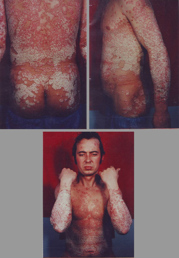 Psoriasis-Vulgaris-Generalized-inainte-9
