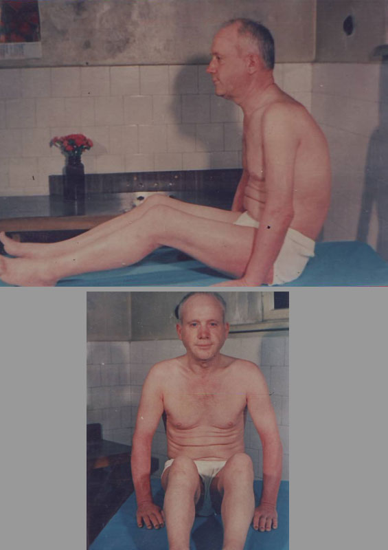 Psoriatic-Erythroderma-dupa-12
