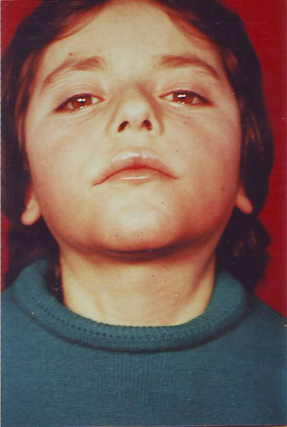 Psoriatic-Erythroderma-dupa-13