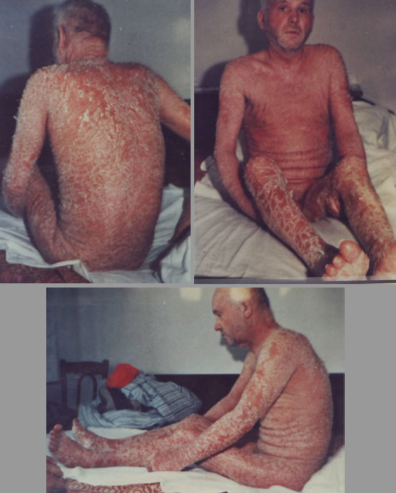 Psoriatic-Erythroderma-inainte-12