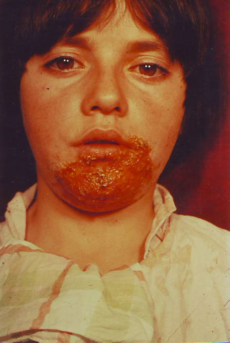 Psoriatic-Erythroderma-inainte-13