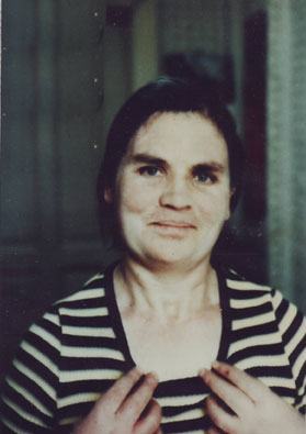 Sistemic-Lupus-dupa-14