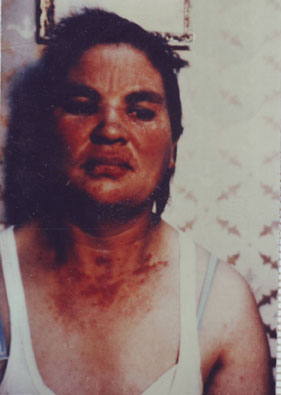 Sistemic-Lupus-inainte-14